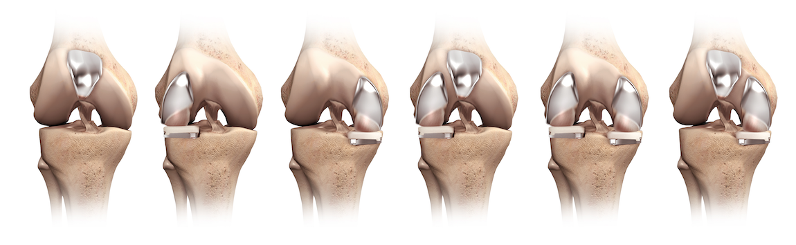 partial-knee-replacement-surgery